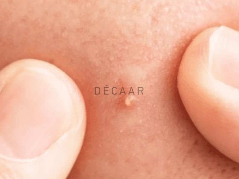 kem trị mụn đầu trắng